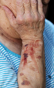 nursing home abuse neglect