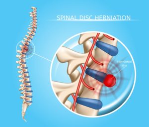 New York Spinal Cord Injury lawyer Jacoby and Meyers LLP